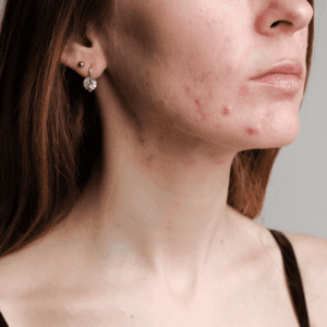 Woman with acne on her jaw and chin area