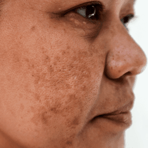 Melasma on cheek and under nose area