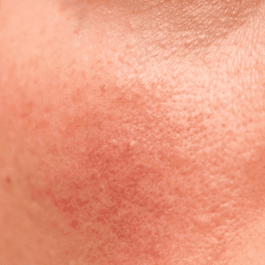 close up of rosacea skin
