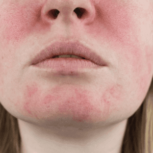 rosacea on the chin and face