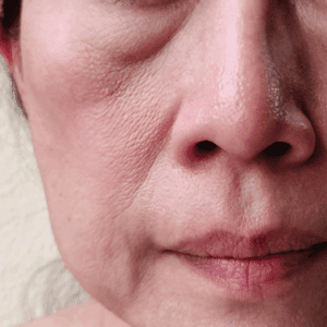 sagging skin on the face for women