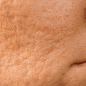 acne scarring on the cheeks