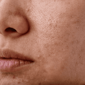 dull skin around the cheeks and mouth area