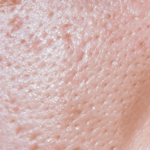zoomed in shot of enlarged pores