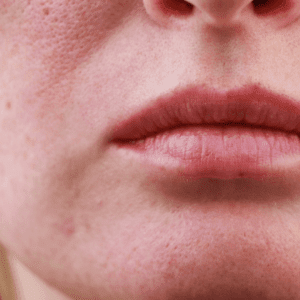 enlarged pores on the cheek and chin area