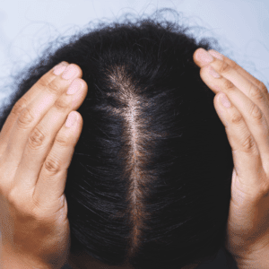 Picture of Hair loss at the top of the head