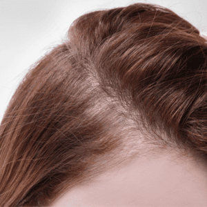 thinning womens hair