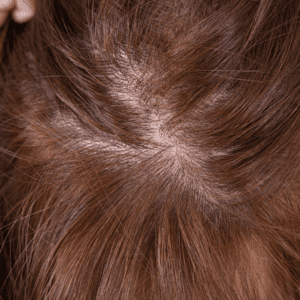 women with thinning hair