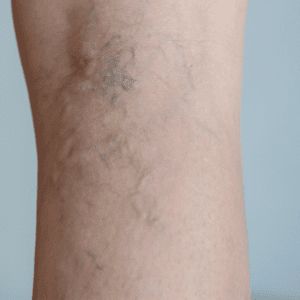thread veins on the back of legs