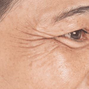 wrinkles and fine lines around the eye area