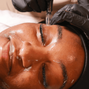 microneedling face and body treatments
