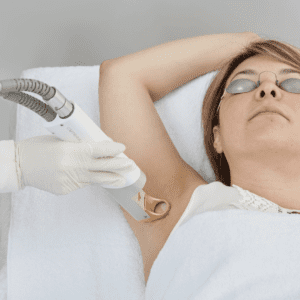 cutera laser hair removal on underarms for women