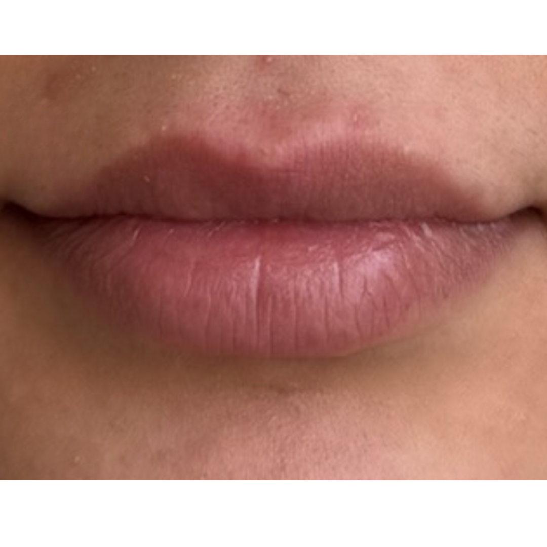 lip filler before picture