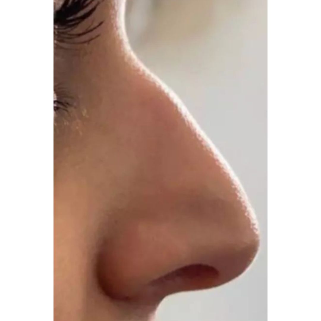 nose filler patient before