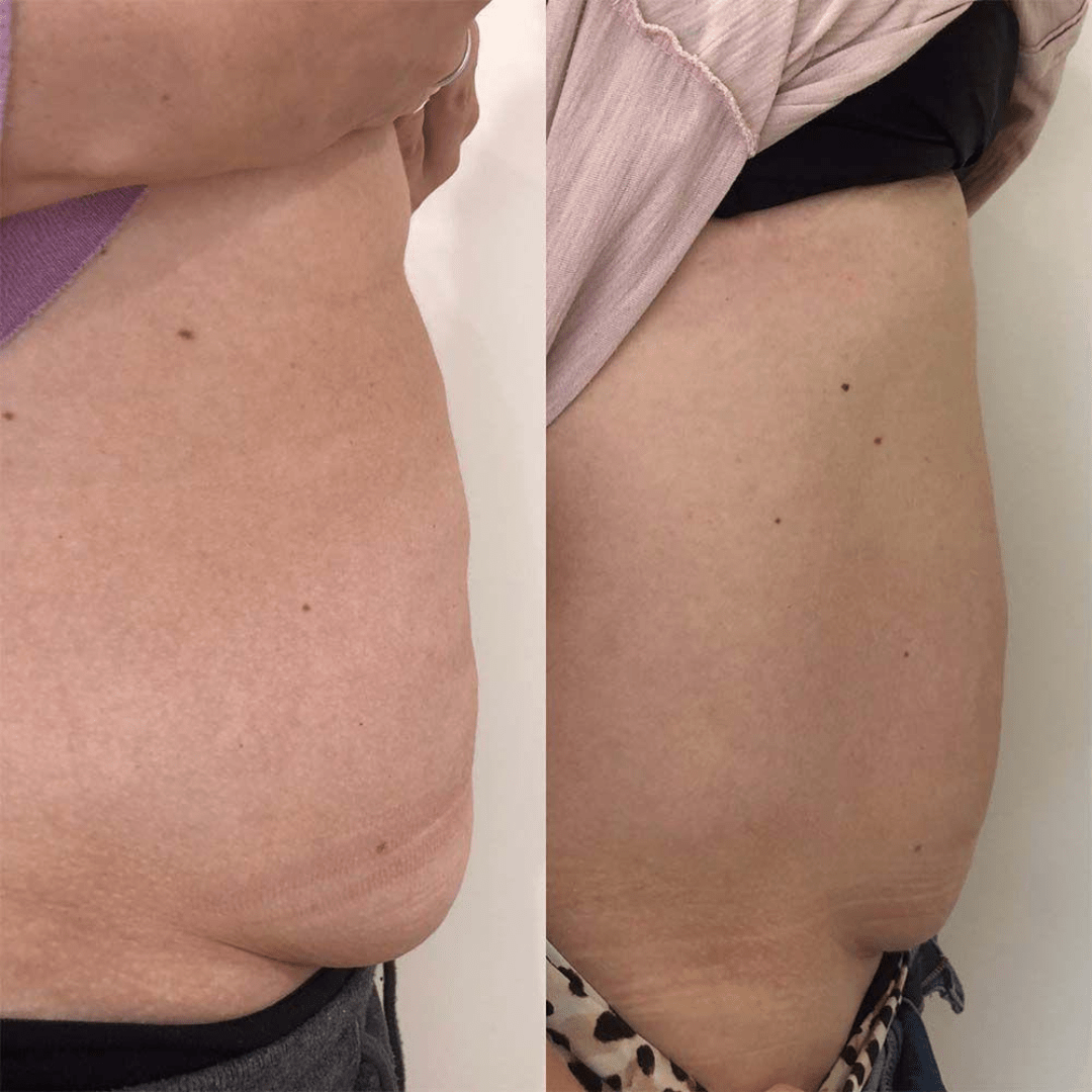 aqualyx before and after picture stomach