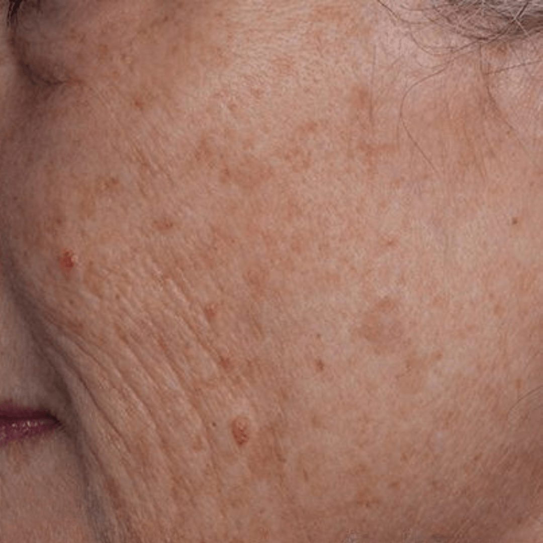 laser hair removal facial pigmentation laser after