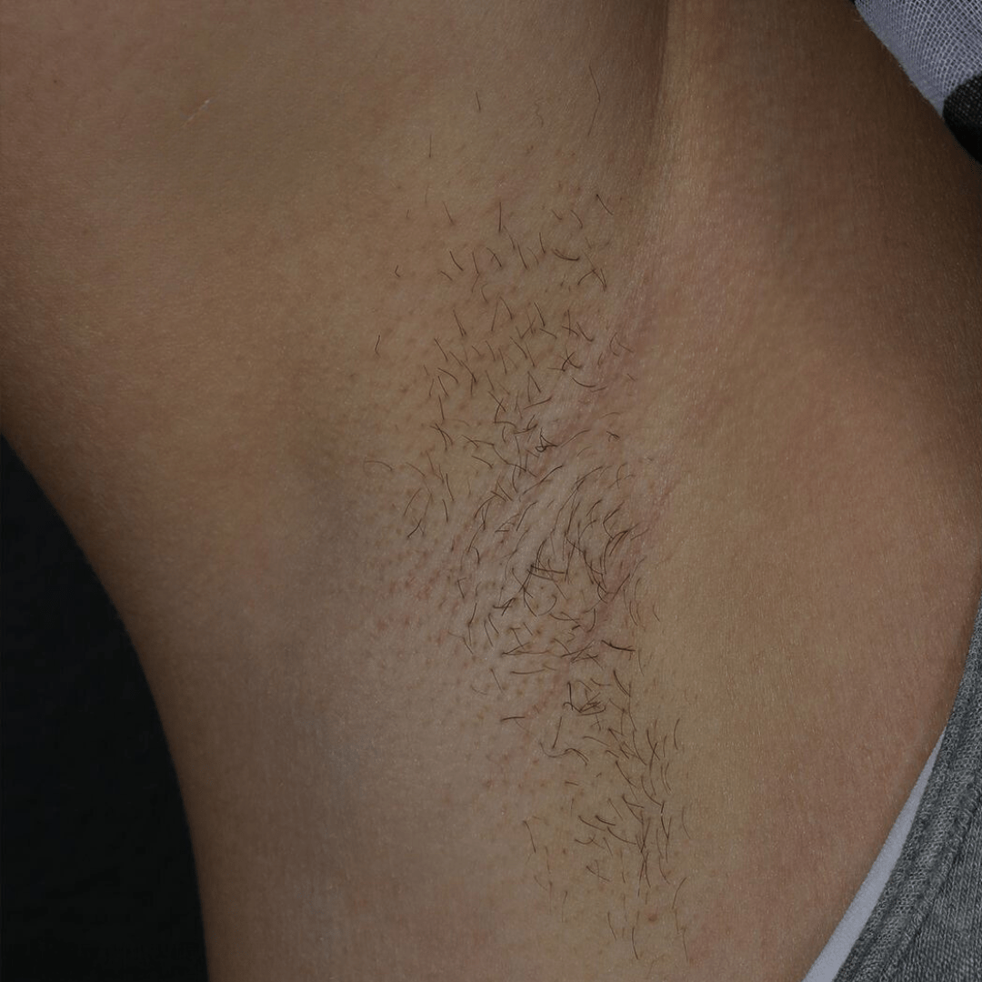 laser hair removal before armpit area