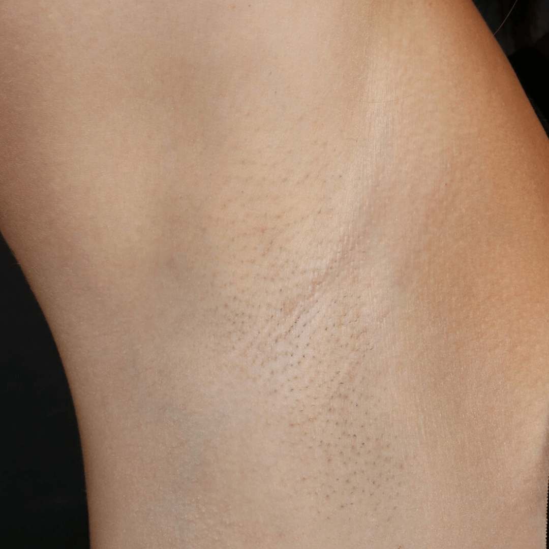 laser hair removal afterarmpit area
