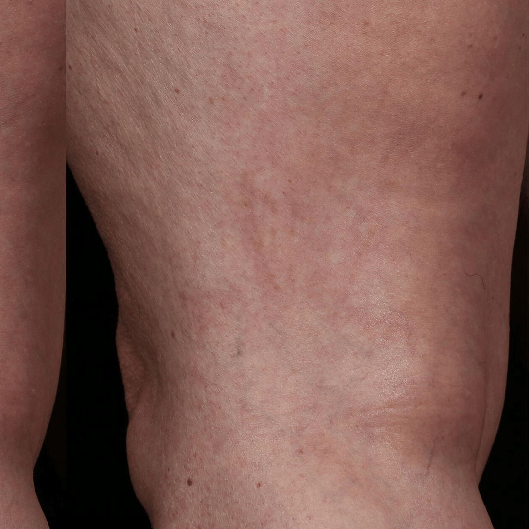 laser hair removal therad veins after
