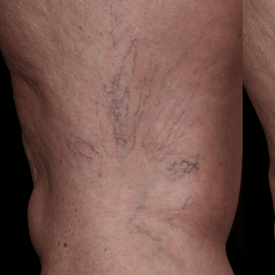 laser hair removal therad veins after