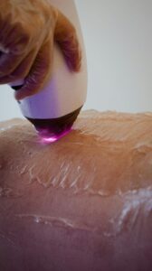 Laser hair removal